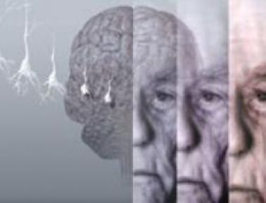 Alzheimer hastalarına müjde